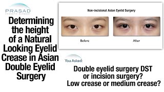 Eyelid Crease Height in Asian Double Eyelid Surgery is Determined by What Would Look Natural