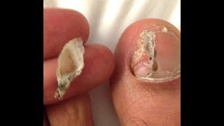 Toenail Torn Off? Try This!