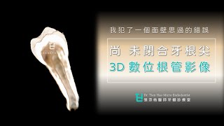 我犯了一個面壁思過的錯誤。未閉合牙根尖。3D數位根管影像(08)