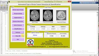 Matlab Code for Brain Tumor Types Detection and Classification Using Image Processing