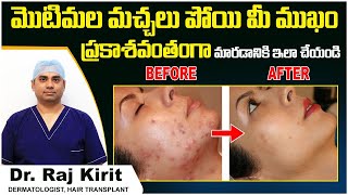 మొటిమల మచ్చలు | Best Treatment For Acne Scars | Skincare Tips in Telugu | Celestee Skin Clinic