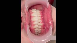 Impacted canine retraction #braces #orthodontics