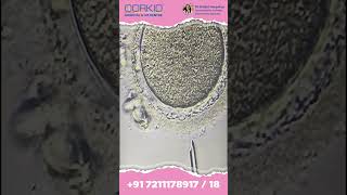 ICSI, Intracytoplasmic Sperm Injection, IVF, Infertility treatment in Surat, Gujarat, IUI in Surat