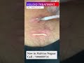 Best Keloid Injection Treatment | Viral #shorts