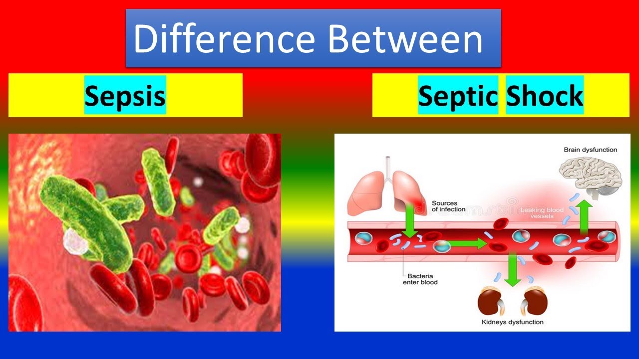 Severe Sepsis And Septic Shock Septic Shock Severe Sepsis Sepsis