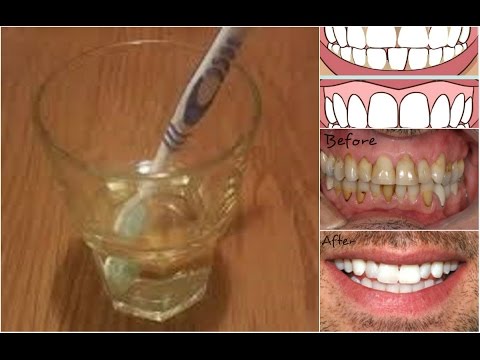 8 Natural Home Remedies to Tooth Enamel Loss Prevention Tips 8 Natural Home Remedies to Tooth Enamel Loss Prevention Tips