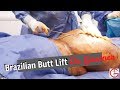 Plump Brazilian Butt Lift| BBL|  Lipo 360| Liposuction| Dr. Gartner| Gartner Plastic Surgery