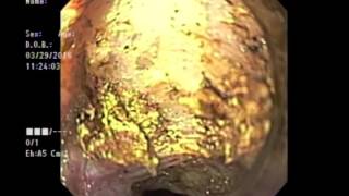 Per-Oral Endoscopic Myotomy for Achalasia