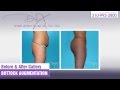 Buttock Augmention Before & Afters | Dr. J Plastic Surgery | Payam Jarrah-Nejad