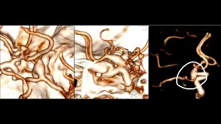 FUSIFORM COMPLEX ICA ANEURYSM-MICROSURGERY CLIP RECONSTRUCTION AND OBLITERATION -dr suresh dugani