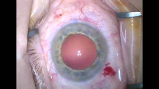 B\u0026L Trulign Implant Right Eye