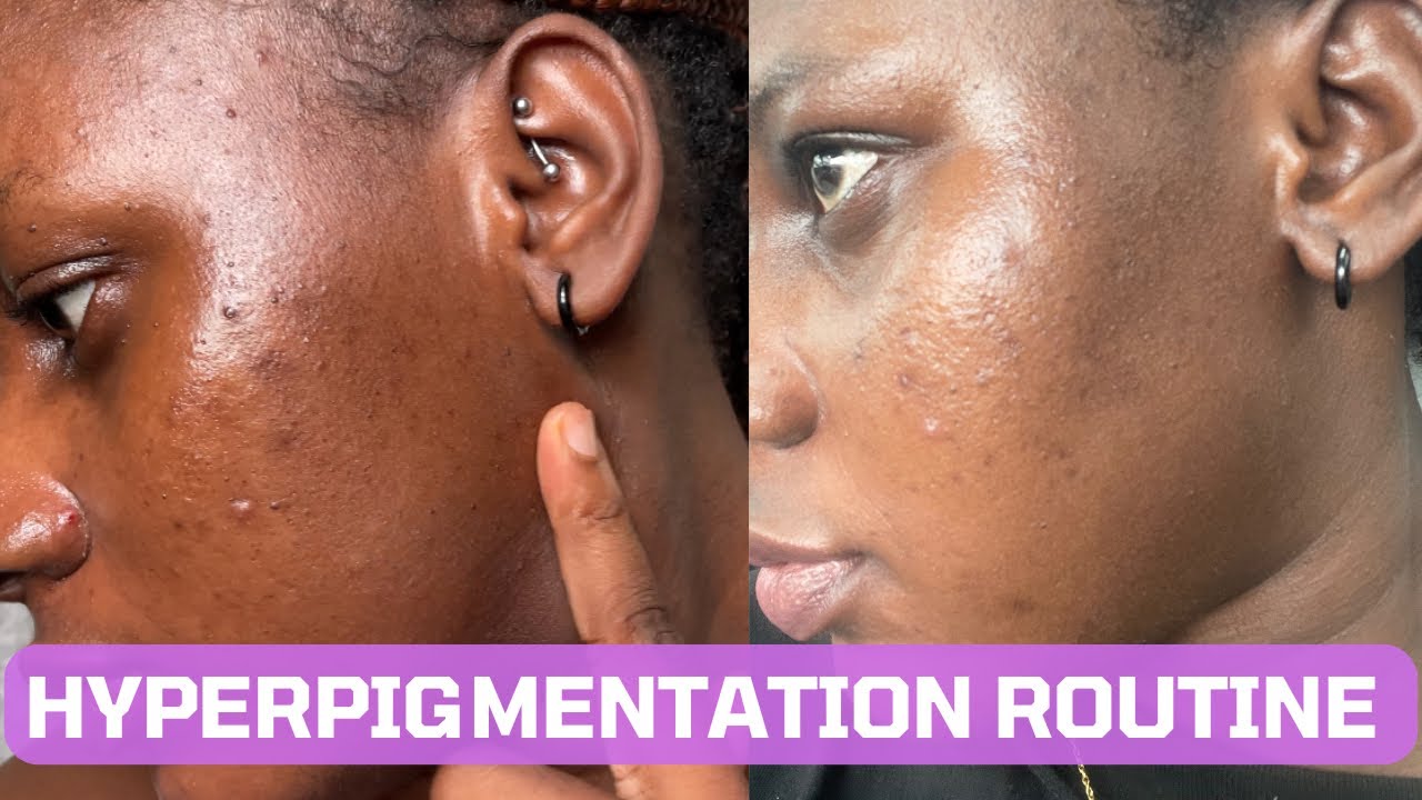 Hyperpigmentation Treatment For Black Skin My Nightime Skincare