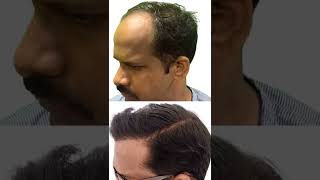 Transformation After Hair Transplant | New Roots Hair Transplant |