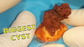 Pimple Popper LOAN NGUYEN // Cyst Removal // Blackhead Removal // Squeezing Pimples #13
