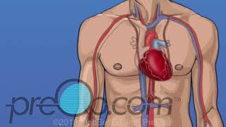 Coronary Artery Bypass Graft (CABG) Surgery - PreOp® Patient Education
