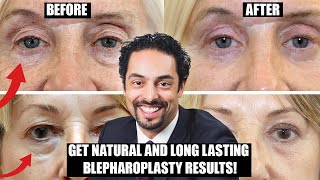 How to get natural and long lasting Blepharoplasty surgery results! - Dr. Julian De Silva