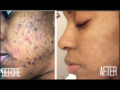 SKIN| How I Got Rid of Dark Scars (Hyperpigmentation) & Acne + GIVEAWAY! SKIN| How I Got Rid of Dark Scars (Hyperpigmentation) & Acne + GIVEAWAY!
