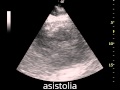 Arresto cardiocircolatorio: asistolia o FV a onde fini?  -emergency ultrasound-