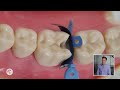 how to marginal ridge heights in class ii restorations tips from dr lincoln harris