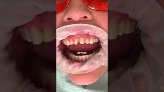 Composite vs porcelain veneers | which is best for you? | Dr. Yazdan | veneers before and after