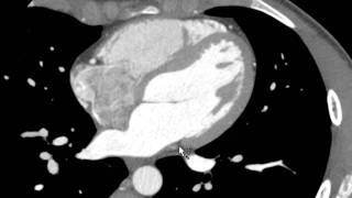 Coronary Veins on Axial CT