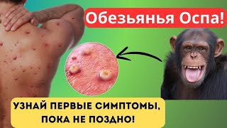 Оспа Обезьян: Пугающие Симптомы