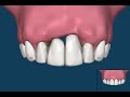 Which is better a dental bridge or implant