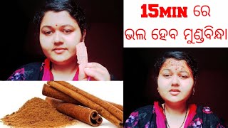 ମାତ୍ର ଗୋଟିଏ ଡାଲଚିନି ରେ ଭଲ ହେବ ମୁଣ୍ଡବିନ୍ଧା#OdiaVlog#NibeditaPandaAcharya#2022