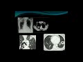 CT lung nodules and ILD