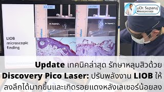 เทคนิคล่าสุดรักษาหลุมสิวด้วยเทคนิคโปรแกรมDiscovery Pico Laser:การปรับพลังงานLIOBให้ลงลึกได้มากขึ้น