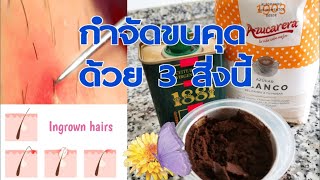 💠วิธีกำจัดขนคุด​ด้วย​สูตร​ธรรมชาติ​จาก​ 3​ สิ่งนี้💠ผิวนุ่ม​ ชุ่ม​ชื้น​ ใสดูมีออ​ร่า​ ในครั้งแรกที่ทำ