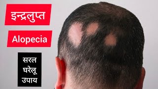 इन्द्रलुप्त (Alopecia) । बालों की समस्या । Dr. Ashok Ayodhyavasi