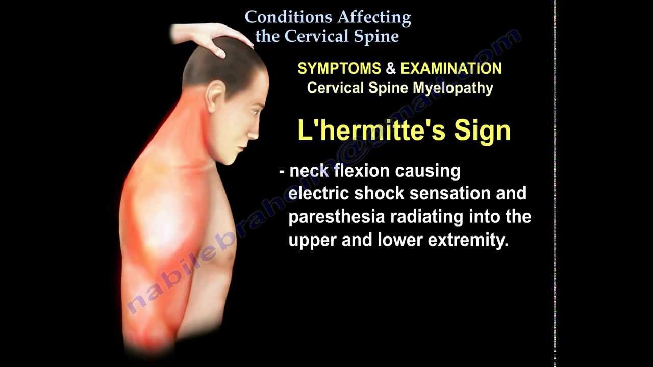 Conditions Affecting The Cervical Spine - Everything You Need To Know ...