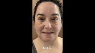 FACE LIFT AND 4-LID BLEPHAROPLASTY RECOVERY