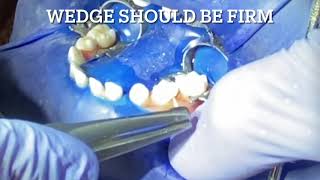 Dental Assistant Training - Placing a wedge