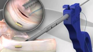 Meniscal Cinch™