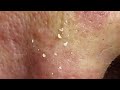 relaxation pimple popping and satisfying blackhead remove