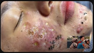 Relaxation pimple popping and satisfying blackhead remove