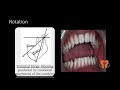 Dental Occlusion - 2 | Mandibular movements|Canine guided occlusion |Group function occlusion