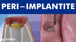 Peri-implantite - infecção de implante dentário ©