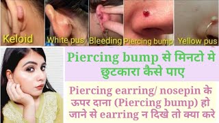 Piercing bumps गायब करने का आसान व घरेलू उपाय/Piercing के बाद earring/nosepin दिख नही रहा तो ये करे