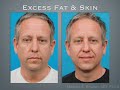 dr. bogdan discusses neck lift and facelift surgery for dallas residents