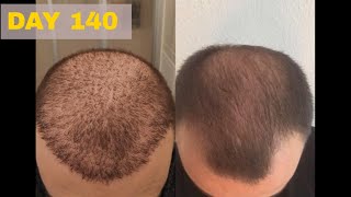 Hair Transplant Results - 140 Days, FUE Turkey