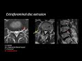 Lumbar Spine MRI by Eric Tranvinh, MD, Stanford Radiology
