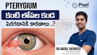 Pterygium: Causes, Symptoms \u0026 Treatment - Reasons for Pterygium | Dr Abdul Rasheed