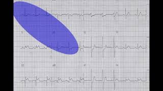 Emergency Medicine CME & Pearls of EKG Interpretation/ ECG Interpretation