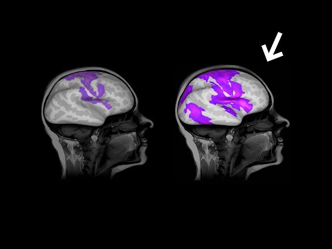 Normal Brain vs. Brain.fm Brain