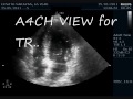 ACUTE MR - CHORDAE RUPTURE -ECHOCARDIOGRAPHY SERIE