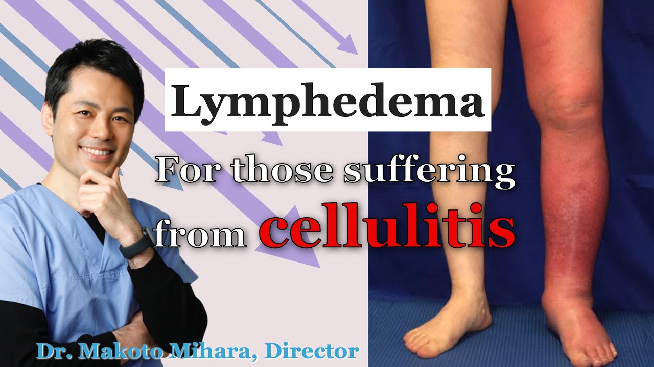 【For Lymphedema Patients】Preventing Cellulitis In Lymphedema: The ...