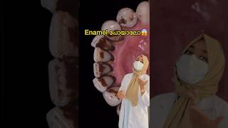 എന്തിനാ പേടിക്കുന്നേ⁉️#dentist #malayalam #dentalcleaning #youtubeshorts #viral #teethwhitening